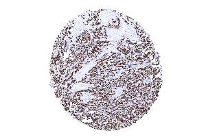 Invasive lobular breast cancer showing strong diffuse CKpan positivity in tumor cells