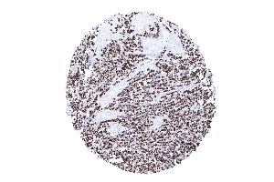 Invasive lobular breast cancer showing strong diffuse CKpan positivity in tumor cells (Recombinant pan Keratin anticorps)