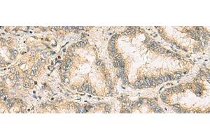 Immunohistochemistry of paraffin-embedded Human lung cancer tissue using NANP Polyclonal Antibody at dilution of 1:65(x200) (NANP anticorps)