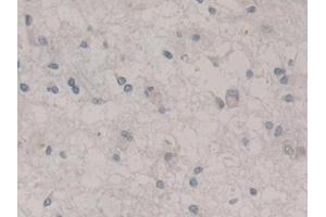 Detection of NES in Human Glioma Tissue using Monoclonal Antibody to Nestin (NES)