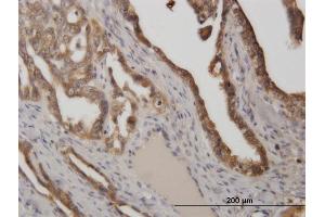 Immunoperoxidase of monoclonal antibody to STIP1 on formalin-fixed paraffin-embedded human ovarian cancer. (STIP1 anticorps  (AA 1-543))