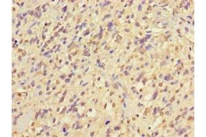 Immunohistochemistry of paraffin-embedded human glioma using ABIN7169120 at dilution of 1:100 (NIM1 anticorps  (AA 1-436))