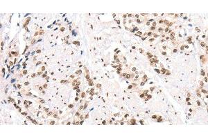 Immunohistochemistry of paraffin-embedded Human prostate cancer using CTBP2 Polyclonal Antibody at dilution of 1:40 (CTBP2 anticorps)