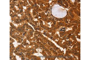 Immunohistochemistry of Human liver cancer using IKZF3 Polyclonal Antibody at dilution of 1:60 (IKZF3 anticorps)