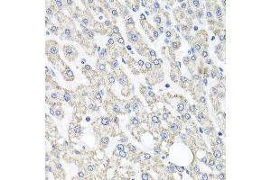 Immunohistochemistry of paraffin-embedded human liver injury using OTC antibody.