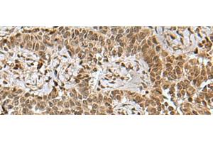 Immunohistochemistry of paraffin-embedded Human ovarian cancer tissue using BCL7B Polyclonal Antibody at dilution of 1:85(x200)