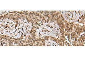 Immunohistochemistry of paraffin-embedded Human ovarian cancer tissue using BCL7B Polyclonal Antibody at dilution of 1:85(x200) (BCL7B anticorps)