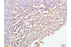 Formalin-fixed and paraffin embedded human cervical cancer labeled with Anti P45017A1 Polyclonal Antibody,Unconjugated  at 1:200 followed by conjugation to the secondary antibody and DAB staining. (CYP17A1 anticorps  (AA 24-65))