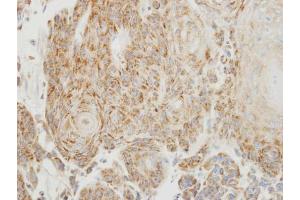 IHC-P Image Immunohistochemical analysis of paraffin-embedded human oral cancer, using PGP9. (UCHL1 anticorps  (C-Term))