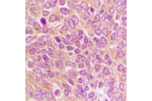 Immunohistochemical analysis of Caspase 9 p35 staining in human breast cancer formalin fixed paraffin embedded tissue section. (Caspase 9 p35 (C-Term) anticorps)