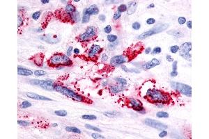 Anti-GPR116 antibody IHC of human Brain, Glioblastoma.