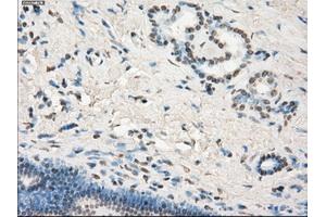 Immunohistochemical staining of paraffin-embedded Adenocarcinoma of colon tissue using anti-LTA4Hmouse monoclonal antibody. (LTA4H anticorps)