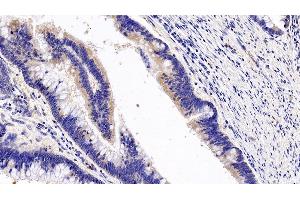 Detection of GCSFR in Human Colorectal cancer Tissue using Polyclonal Antibody to Colony Stimulating Factor Receptor, Granulocyte (GCSFR)