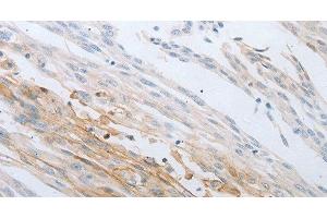 Immunohistochemistry of paraffin-embedded Human cervical cancer using LOX Polyclonal Antibody at dilution of 1:30 (LOX anticorps)