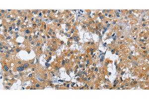 Immunohistochemistry of paraffin-embedded Human thyroid cancer tissue using CREB2 Polyclonal Antibody at dilution 1:40 (ATF4 anticorps)