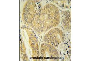 ENAM antibody immunohistochemistry analysis in formalin fixed and paraffin embedded human prostate carcinoma followed by peroxidase conjugation of the secondary antibody and DAB staining.
