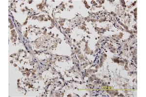 Immunoperoxidase of monoclonal antibody to ACTN4 on formalin-fixed paraffin-embedded human lung adenocarcinoma.