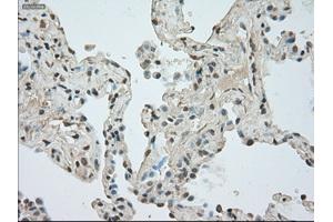 Immunohistochemical staining of paraffin-embedded Adenocarcinoma of breast tissue using anti-NAT8 mouse monoclonal antibody. (NAT8 anticorps)
