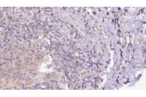 ABIN6273162 at 1/100 staining Human lymph cancer tissue by IHC-P. (SH2D1B anticorps  (Internal Region))