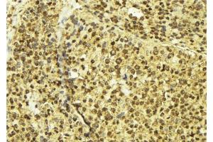 ABIN6277602 at 1/100 staining Human breast cancer tissue by IHC-P. (OTX2 anticorps  (Internal Region))