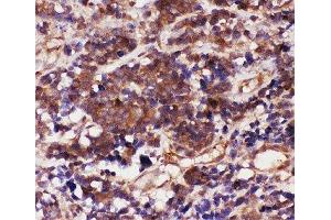 IHC-P: Caspase-3 antibody testing of human lung cancer tissue