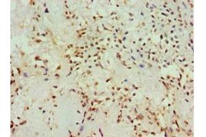 Immunohistochemistry of paraffin-embedded human breast cancer using ABIN7142904 at dilution of 1:100 (AKAP13 anticorps  (AA 1-150))