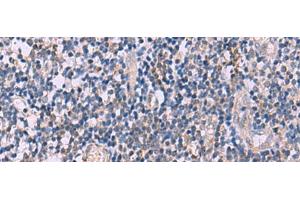 Immunohistochemistry of paraffin-embedded Human tonsil tissue using IL4R Polyclonal Antibody at dilution of 1:45(x200)