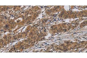 Immunohistochemistry of paraffin-embedded Human gasrtic cancer tissue using INPPL1 Polyclonal Antibody at dilution 1:40 (INPPL1 anticorps)
