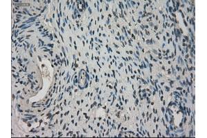 Immunohistochemical staining of paraffin-embedded Adenocarcinoma of breast tissue using anti-NEK6 mouse monoclonal antibody. (NEK6 anticorps)