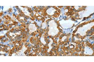 Immunohistochemistry of paraffin-embedded Human thyroid cancer using KRT40 Polyclonal Antibody at dilution of 1:50 (KRT40 anticorps)