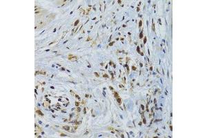 Immunohistochemistry of paraffin-embedded human gastric cancer using GABPB1 Antibody. (GABPB1 anticorps  (AA 231-395))