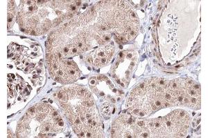 ABIN6267703 at 1/100 staining human kindey carcinoma tissue sections by IHC-P. (PRKAB1 anticorps  (pSer181))