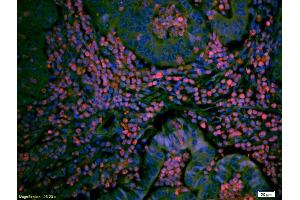 Formalin-fixed and paraffin embedded human breast cancer labeled with Anti TIEG1/KLF10 Polyclonal Antibody, Unconjugated (ABIN735173) at 1:200 followed by conjugation to the secondary antibody Goat Anti-Rabbit IgG, PE conjugated used at 1:200 dilution for 40 minutes at 37°C.