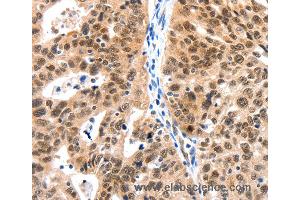 Immunohistochemistry of Human ovarian cancer using LRP5 Polyclonal Antibody at dilution of 1:115 (LRP5 anticorps)