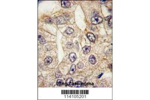 Formalin-fixed and paraffin-embedded human lung carcinoma tissue reacted with CD14 antibody (N-term), which was peroxidase-conjugated to the secondary antibody, followed by DAB staining. (CD14 anticorps  (N-Term))