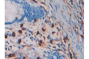 Detection of TPS in Human Colorectal cancer Tissue using Monoclonal Antibody to Tryptase (TPS)