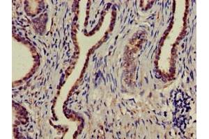 Immunohistochemistry of paraffin-embedded human prostate cancer using ABIN7160004 at dilution of 1:100 (MAPK6 anticorps  (AA 383-712))