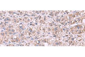 Immunohistochemistry of paraffin-embedded Human liver cancer tissue using GSTCD Polyclonal Antibody at dilution of 1:70(x200) (GSTCD anticorps)