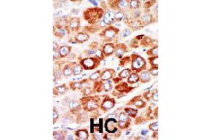Formalin-fixed and paraffin-embedded human hepatocellular carcinoma tissue reacted with AK1 polyclonal antibody  , which was peroxidase-conjugated to the secondary antibody, followed by AEC staining. (Adenylate Kinase 1 anticorps  (C-Term))