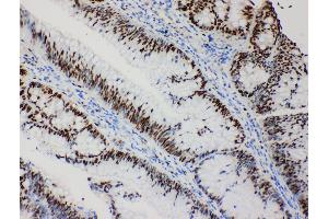 Anti-MCM2 antibody, IHC(P) IHC(P): Human Intestinal Cancer Tissue (MCM2 anticorps  (C-Term))