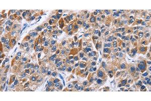 Immunohistochemistry of paraffin-embedded Human liver cancer tissue using ENPP5 Polyclonal Antibody at dilution 1:40 (ENPP5 anticorps)