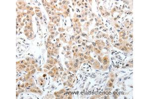 Immunohistochemistry of Human lung cancer using SLC22A3 Polyclonal Antibody at dilution of 1:40