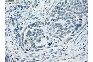 Immunohistochemical staining of paraffin-embedded colon tissue using anti-SSX2mouse monoclonal antibody. (SSX2 anticorps)