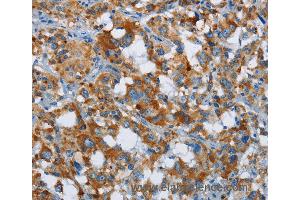 Immunohistochemistry of Human thyroid cancer using ETHE1 Polyclonal Antibody at dilution of 1:20 (ETHE1 anticorps)