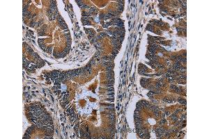 Immunohistochemistry of Human colon cancer using SLC1A6 Polyclonal Antibody at dilution of 1:40 (SLC1A6 anticorps)