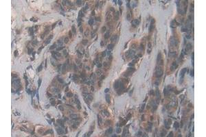 Detection of ACP in Human Breast cancer Tissue using Polyclonal Antibody to Acyl Carrier Protein, Mitochondrial (ACP)