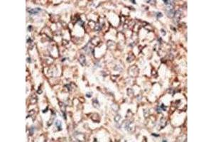 IHC analysis of FFPE human hepatocarcinoma tissue stained with the BMPR1A antibody (BMPR1A anticorps  (AA 166-196))