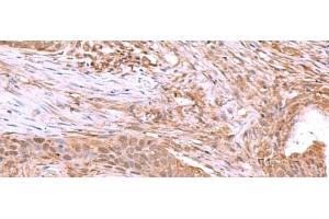 Immunohistochemistry of paraffin-embedded Human esophagus cancer tissue using JDP2 Polyclonal Antibody at dilution of 1:40(x200) (JDP2 anticorps)