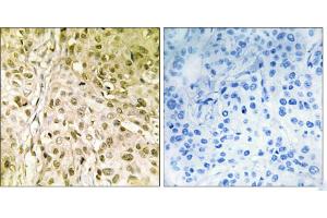 Peptide - +Immunohistochemistry analysis of paraffin-embedded human breast carcinoma tissue, using DNA Polymerase θ antibody.