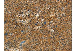 The image on the left is immunohistochemistry of paraffin-embedded Human liver cancer tissue using ABIN7191682(NPAP1 Antibody) at dilution 1/60, on the right is treated with synthetic peptide. (NPAP1 anticorps)